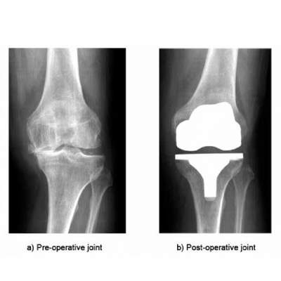 Pre operative joint